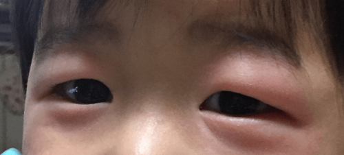 瞼が腫れる原因